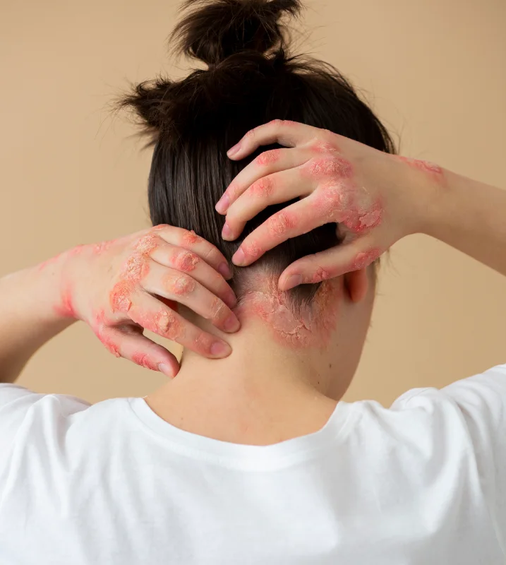 Dolor por infección del herpes