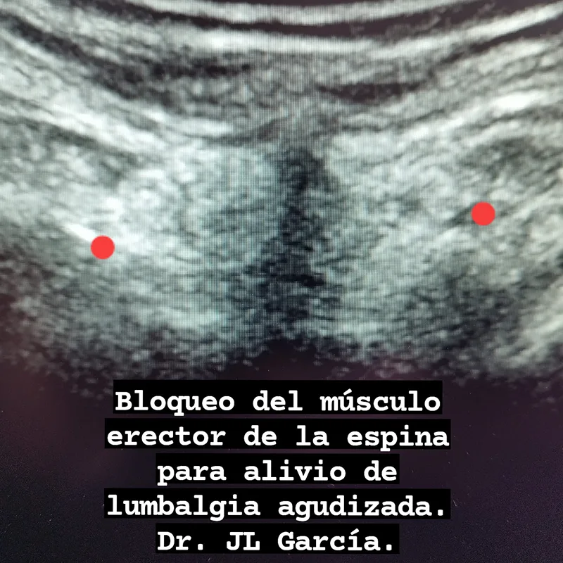 bloqueo del musculo erector de la espina para alivio de lumbalgia agudizada