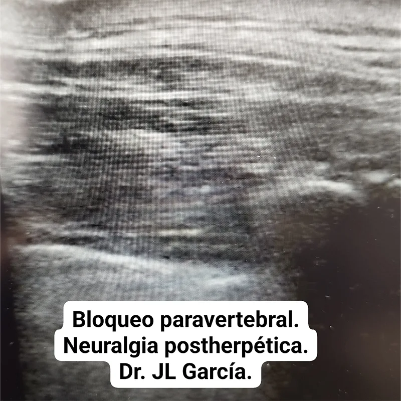 bloqueo paravertebral