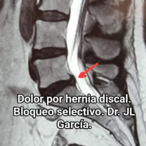 dolor por hernia discal - bloqueo selectivo 2