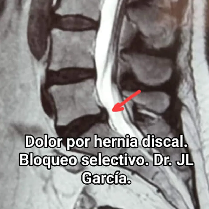 dolor por hernia discal - bloqueo selectivo 2