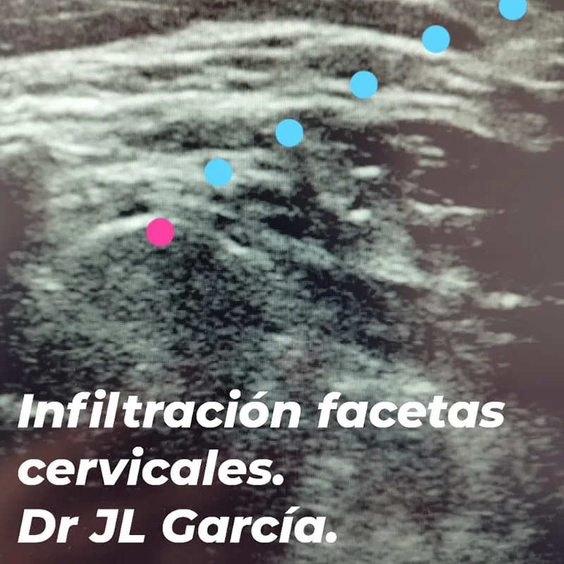 infiltración facetas cervicales