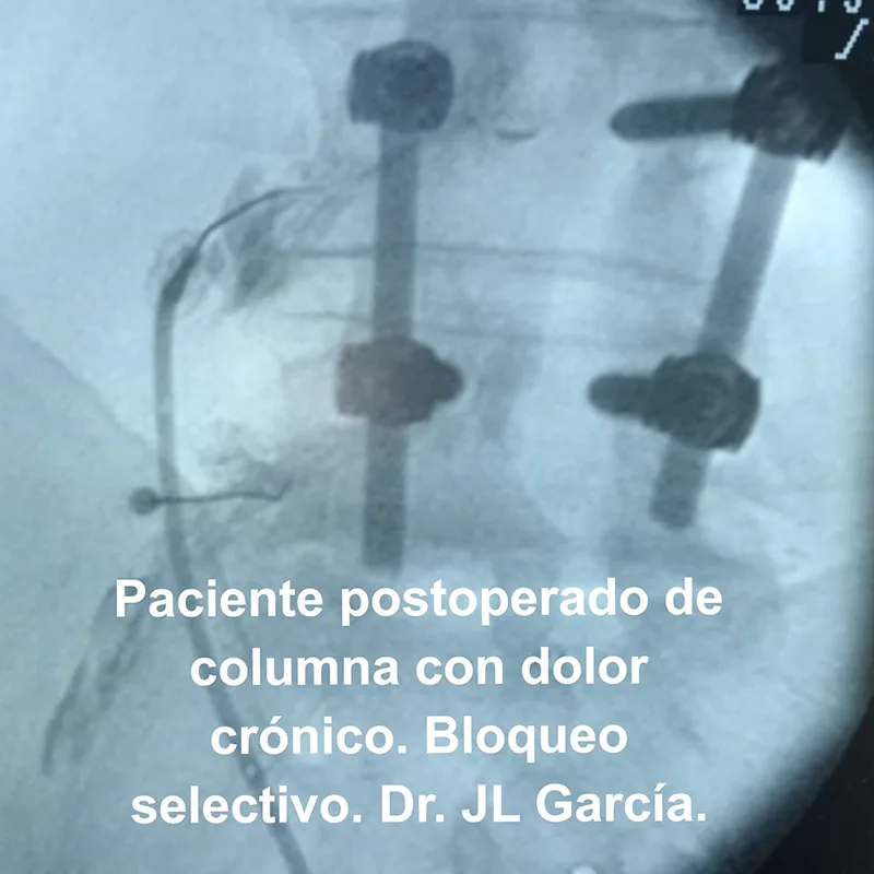 paciente postoperado - bloqueo selectivo