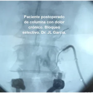 paciente post operado de columna - bloqueo selectivo