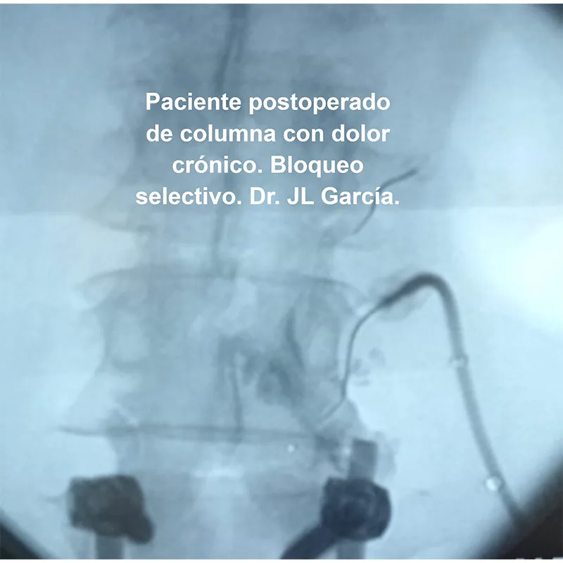 paciente post operado de columna - bloqueo selectivo