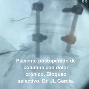 paciente postoperado de columna