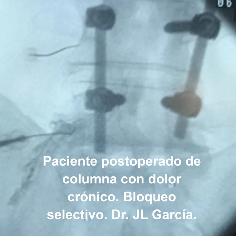 paciente postoperado de columna